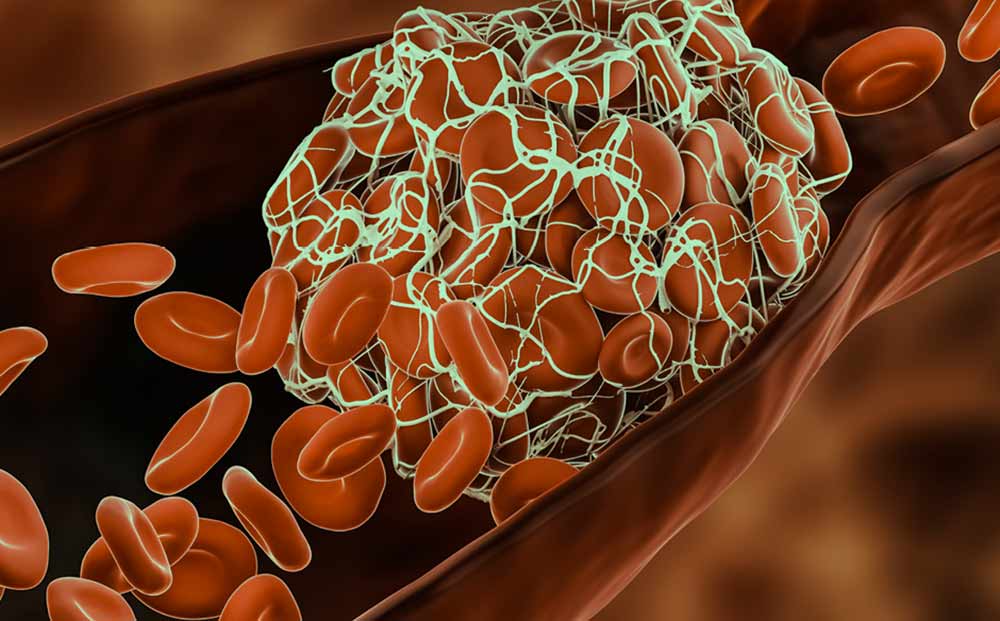 blood-clot